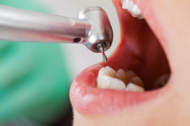 Best Emergency Root Canal Therapy in Middleburg Heights, OH